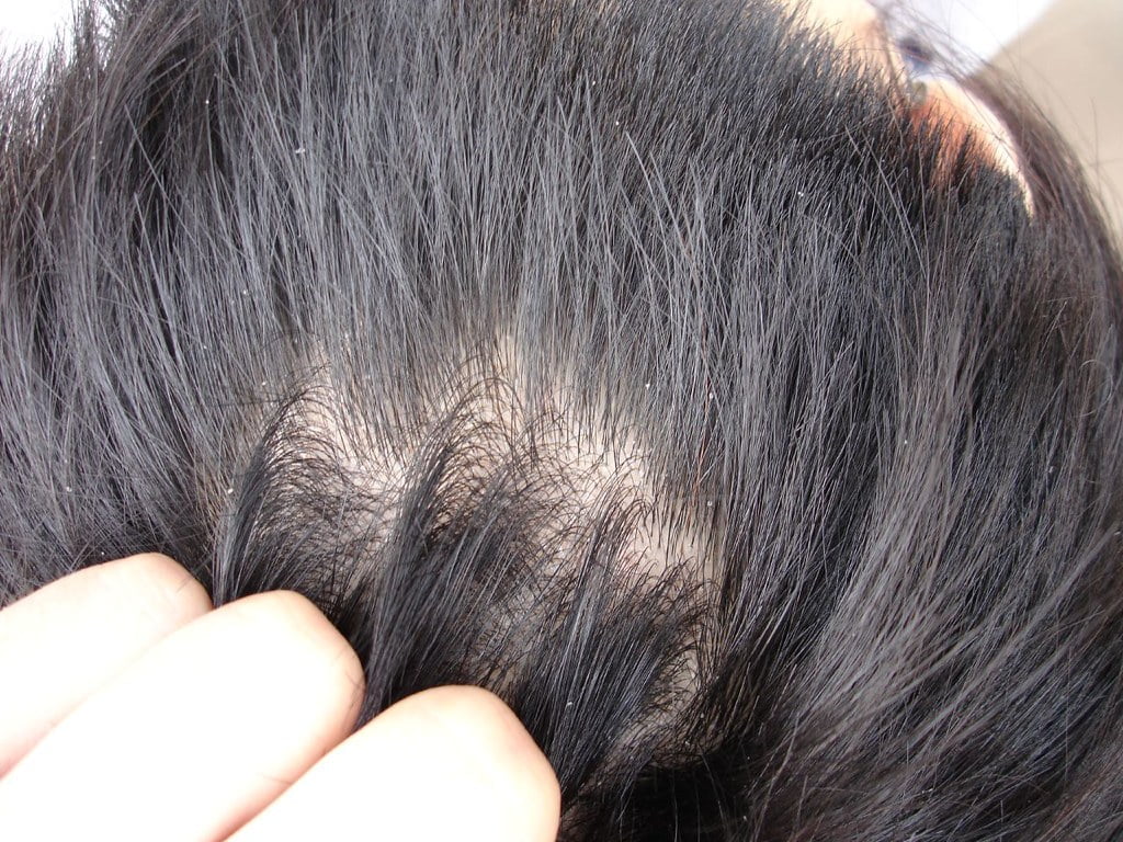 Hair Loss and Thinning