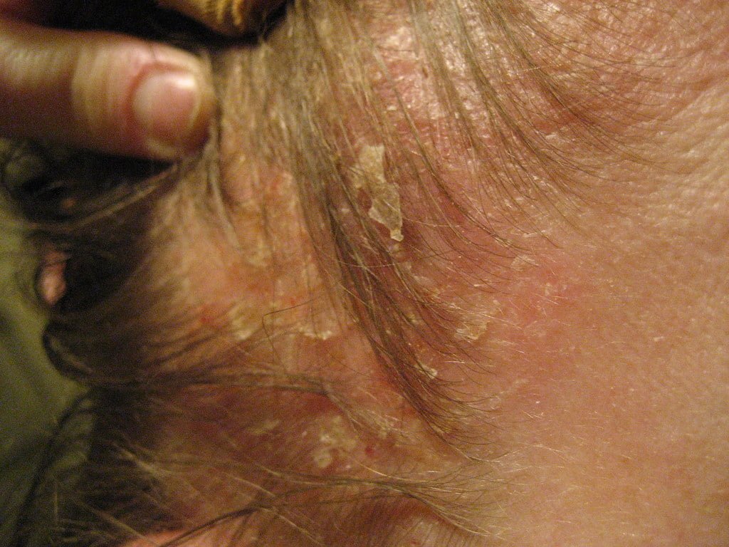 Scalp Psoriasis